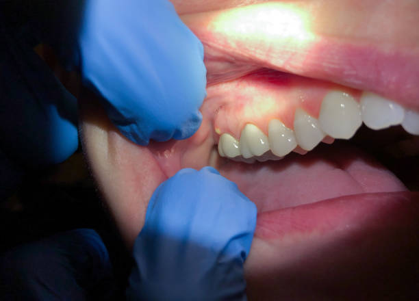 Best Emergency Dental Care for Broken or Chipped Teeth in Millersburg, PA