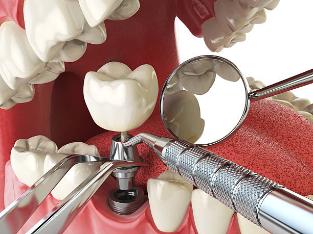 Best Emergency Treatment for Dental Infections or Abscesses in Millersburg, PA
